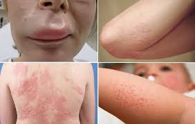 Dị ứng thời tiết - Hình ảnh minh họa